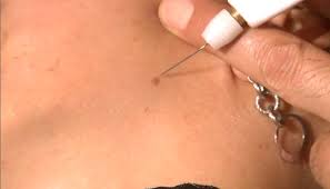 Trattamento acne con plexr Milano